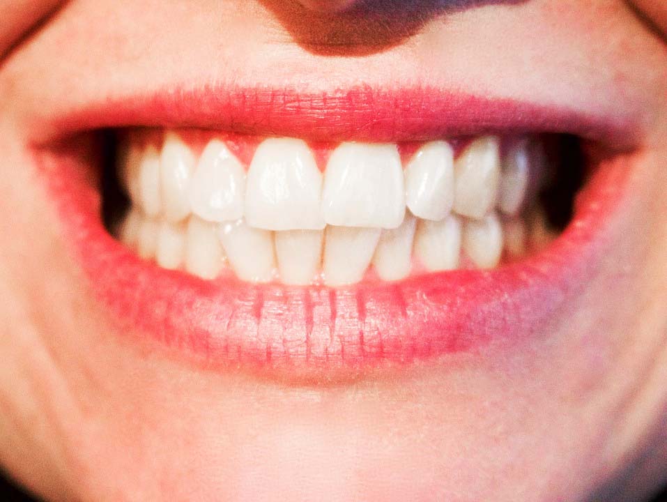 Comment obtenir des dents blanches ?